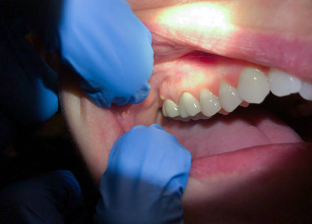 Best Dental Abscess Treatment in Franklin, VA
